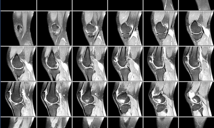 Снимок МРТ колена