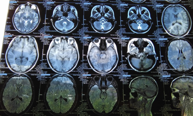 Снимок МРТ головного мозга в ЮАО