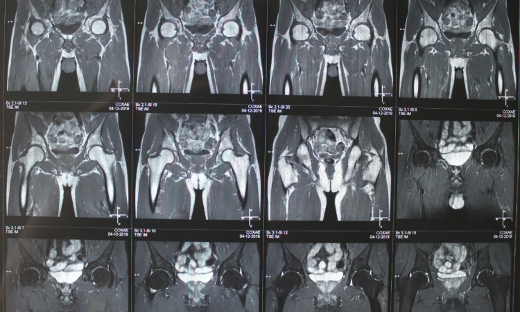 Снимок МРТ тазобедренного сустава