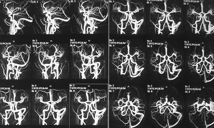 Снимок МРТ сосудов (артерий и вен) мозга