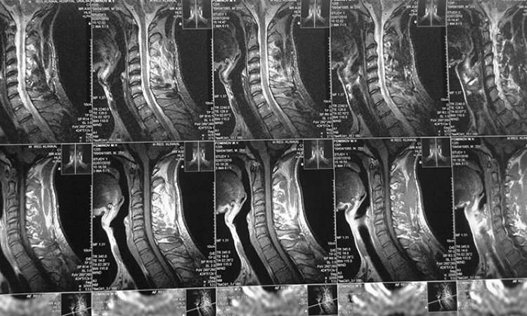 МРТ снимок шейного отдела позвоночника