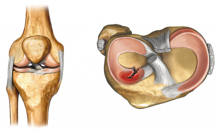 Воспаление коленного мениска: проявление, диагностика и лечение