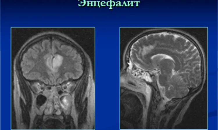 Энцефалит на МРТ