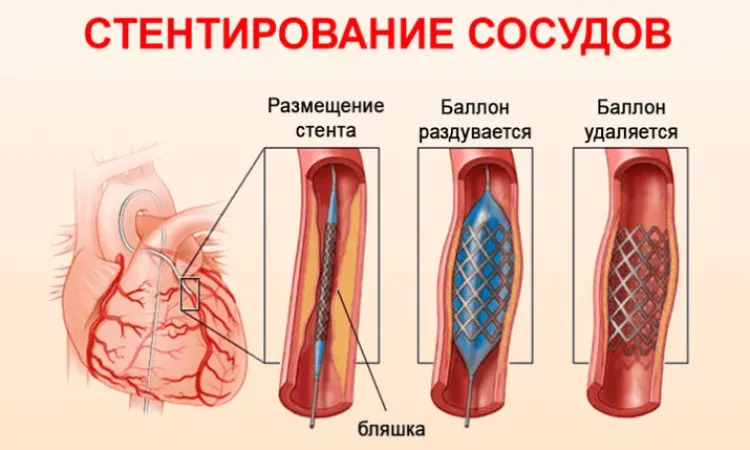Можно ли делать МРТ после стентирования сосудов сердца