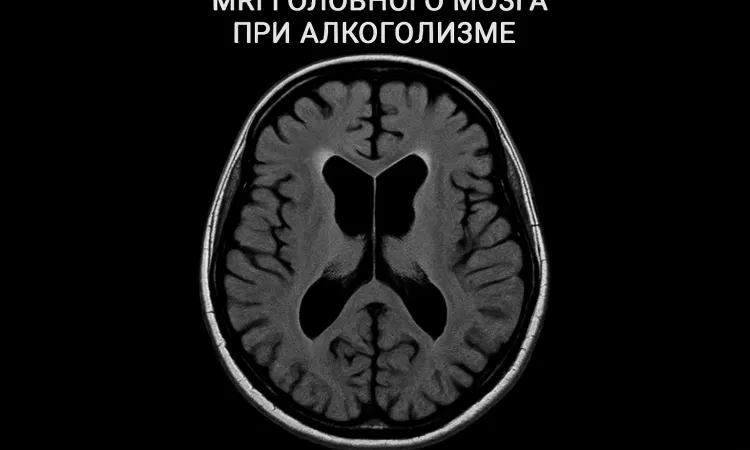 МРТ при алкогольной энцефалопатии