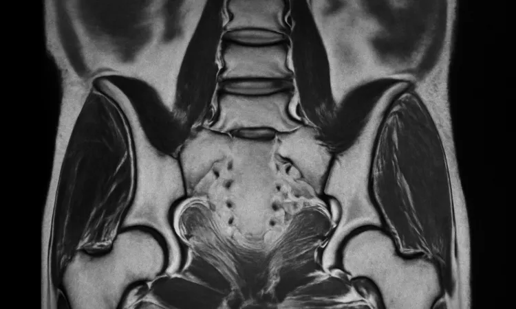 Сакроилеит. Снимок МРТ
