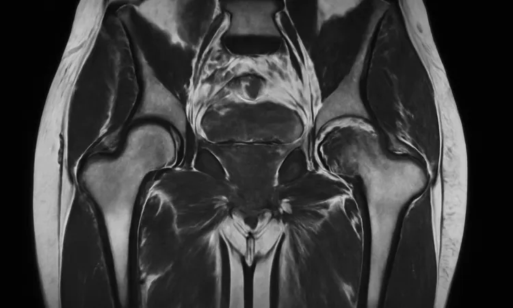 Коксартроз. МРТ снимок