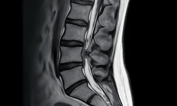 Стеноз позвоночного канала МРТ