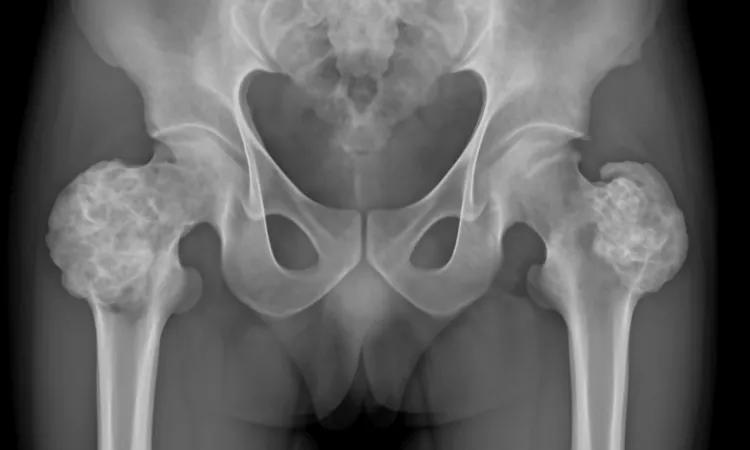 Диагностика новообразований и опухолей тазобедренного сустава