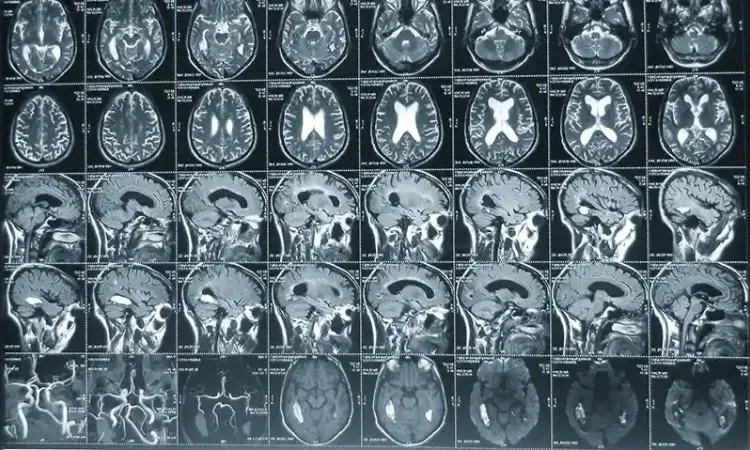 Снимок МРТ головного мозга и сосудов