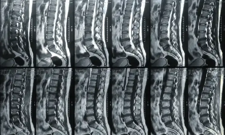 Снимок МРТ позвоночника