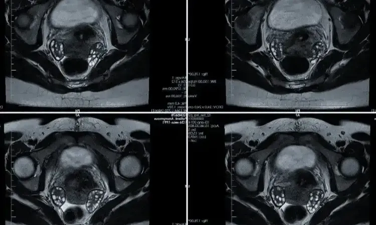Снимок МРТ органов малого таза