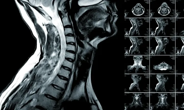 Снимок МРТ шейного отдела позвоночника
