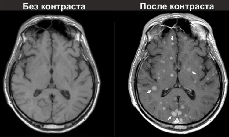 Снимок МРТ без контраста и после контраста