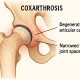 Коксартроз