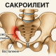 САКРОИЛЕИТ - причины, симптомы, лечение