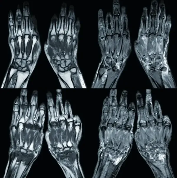 Снимок МРТ кистевого сустава
