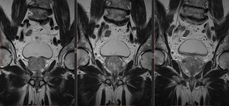 Снимок МРТ простаты