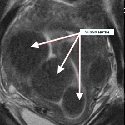 Миома на МРТ