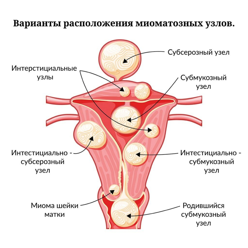 Миоматозные узлы