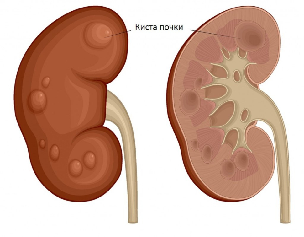 Киста почки