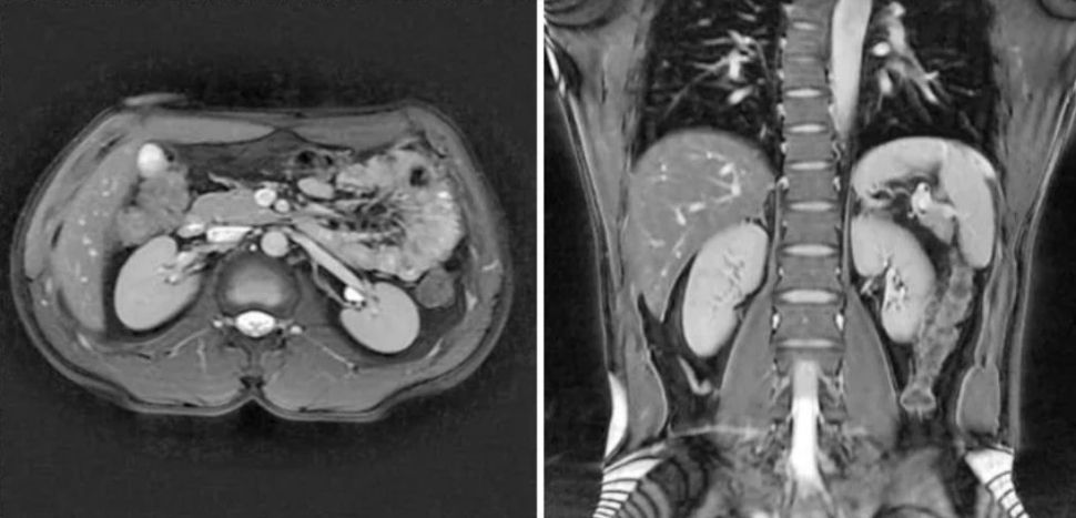 МРТ снимок почек